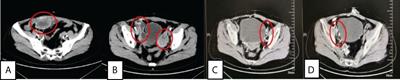 Case report: 125I seed implantation for rare malignant solitary fibrous tumor in the pelvic cavity: a case report